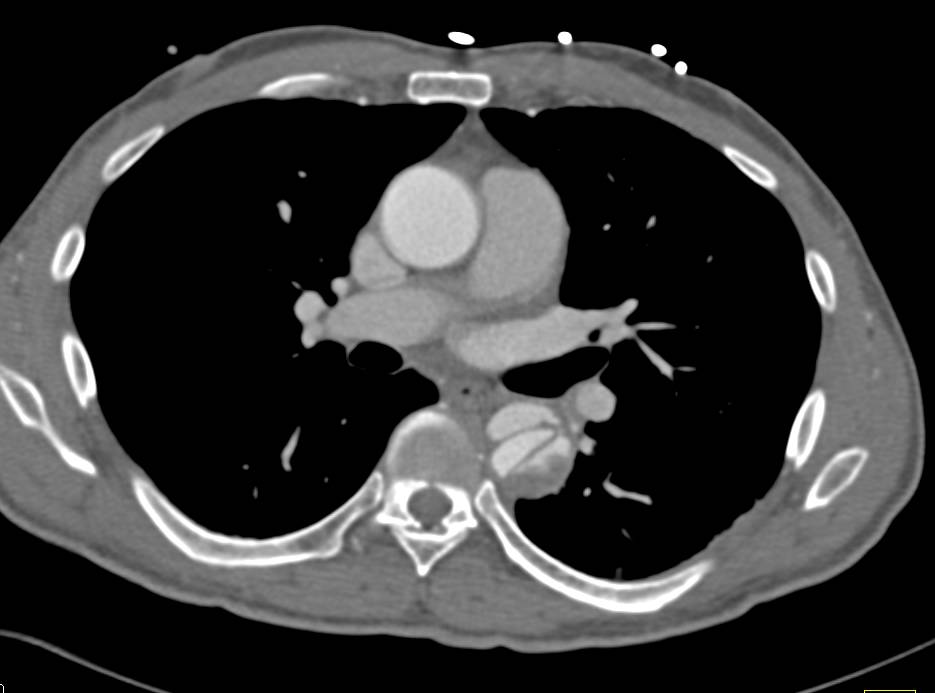 Type B Dissection - CTisus CT Scan