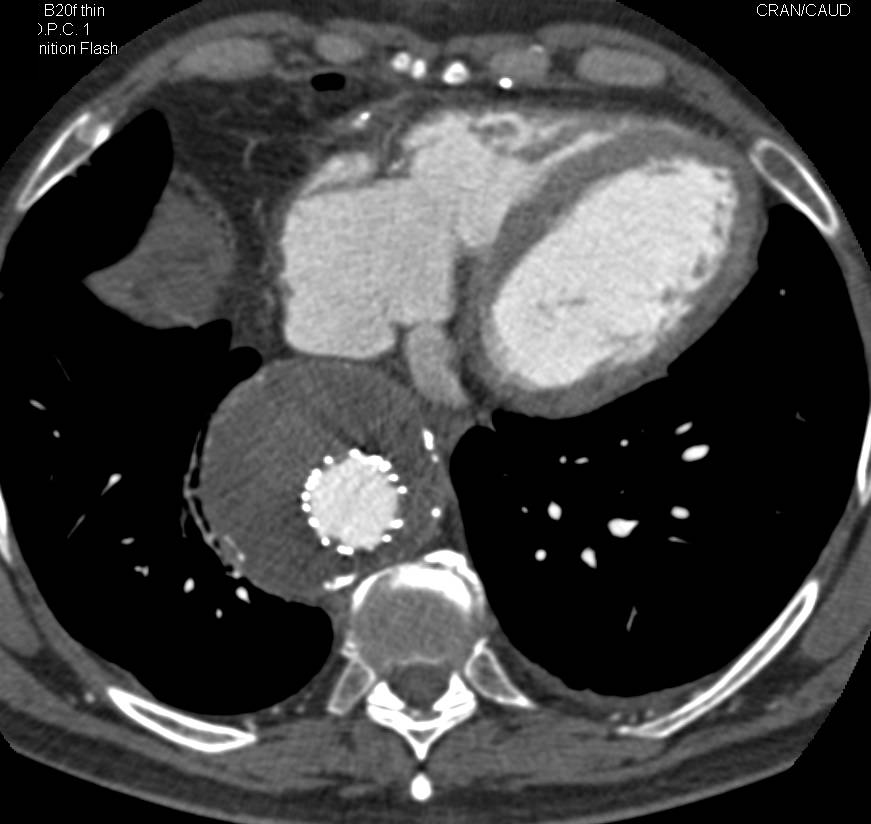 Successful Endovascular Repair of Thoracic Aortic Aneurysm - CTisus CT Scan