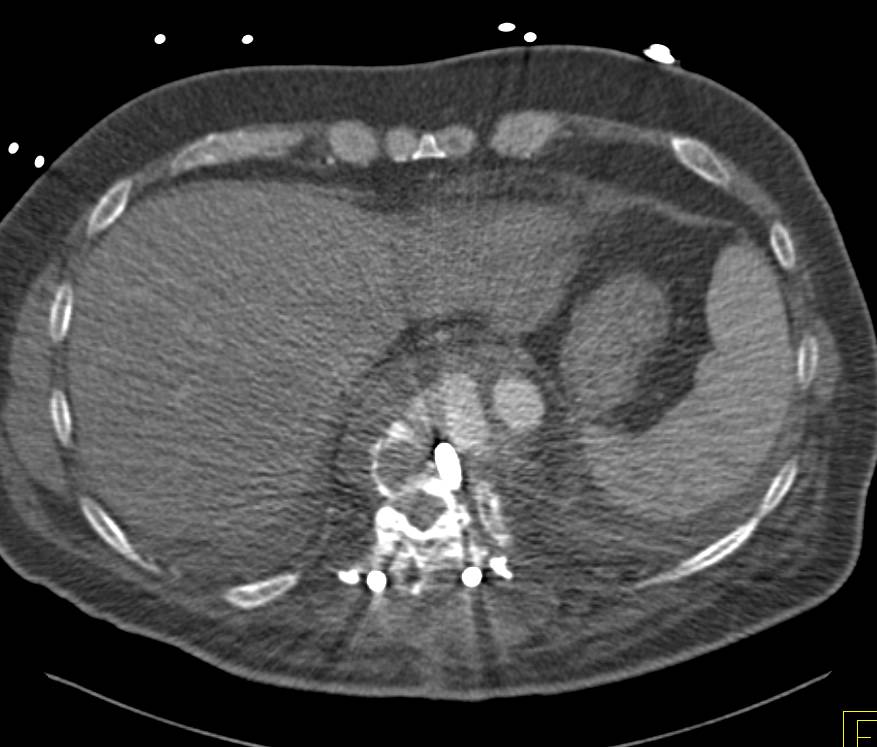 Complex Vascular Repair with Leak off Aorta due to Vascular Trauma and Leak - CTisus CT Scan