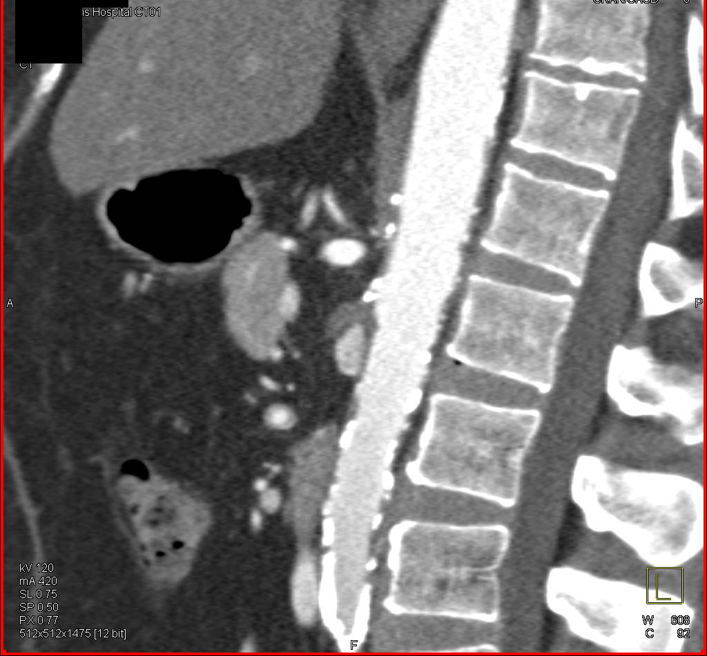 Axillary to Femoral Artery and Fem-Fem Bypass in Patient with Vascular Disease - CTisus CT Scan