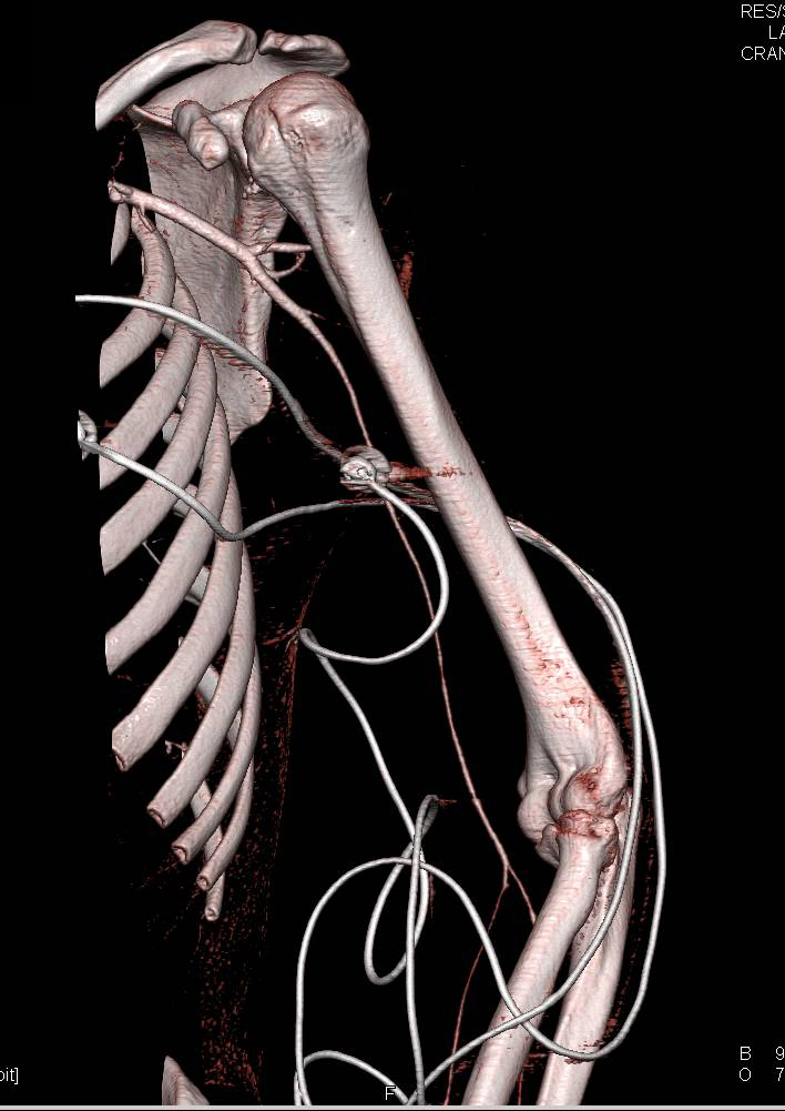 Spasm in the Left Brachial Artery Without Active Bleed - CTisus CT Scan