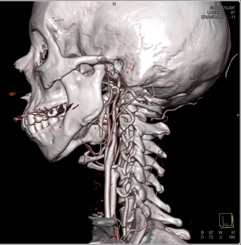 Dilated Aortic Root with Branch Vessels off the Arch and Carotid Circulation - CTisus CT Scan