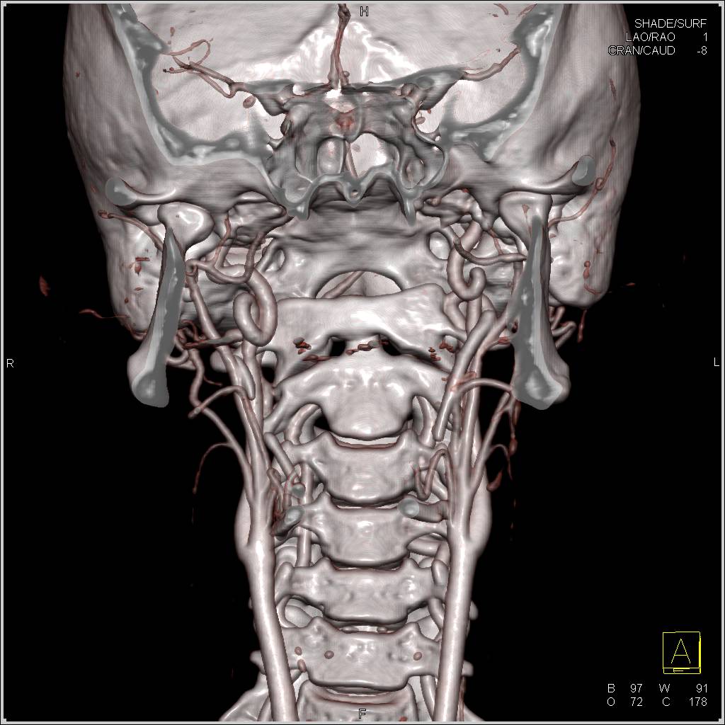 Loeys-Dietz Syndrome with Dilated Aortic Root and Tortuous Carotid Arteries - CTisus CT Scan