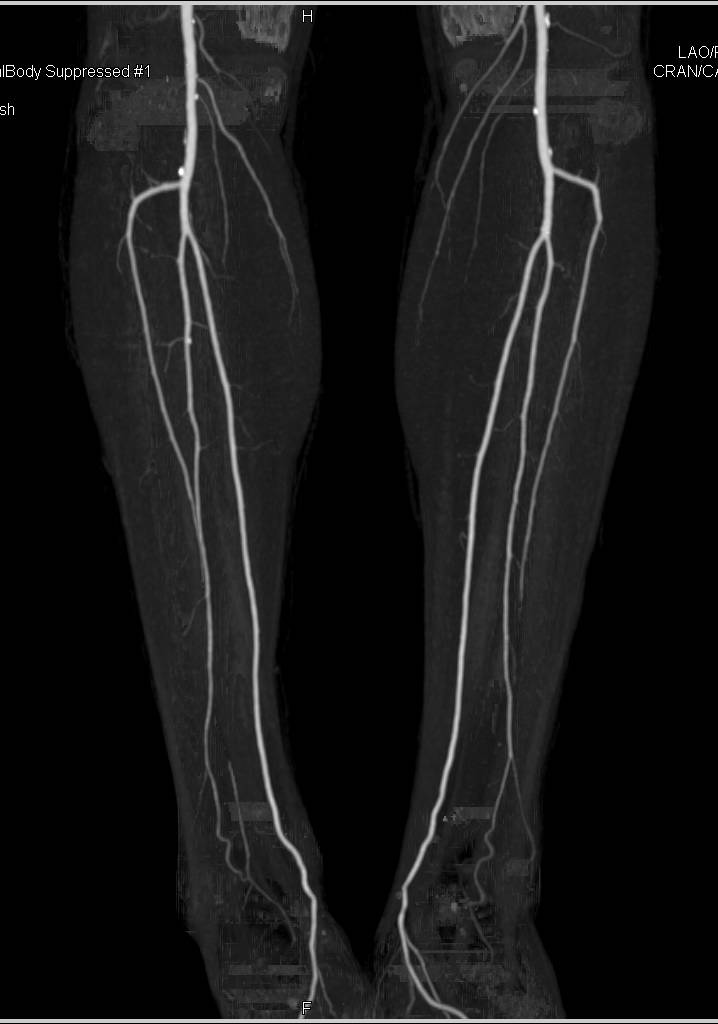 Minimal Disease CT Runoff with Bone Removal - CTisus CT Scan