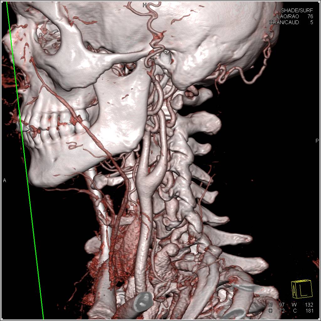 Ectatic Carotid Arteries in Loeys-Dietz Syndrome - CTisus CT Scan