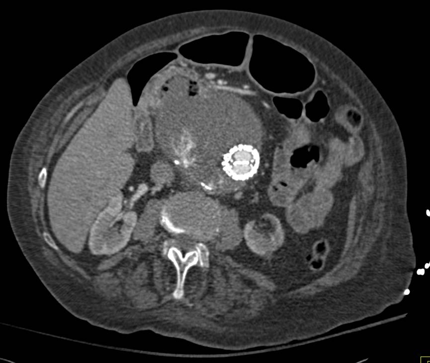 Aorto-enteric Fistulae with Air Bubbles Seen - CTisus CT Scan