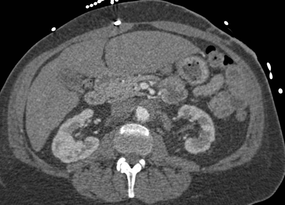 Retroperitoneal Fibrosis - CTisus CT Scan