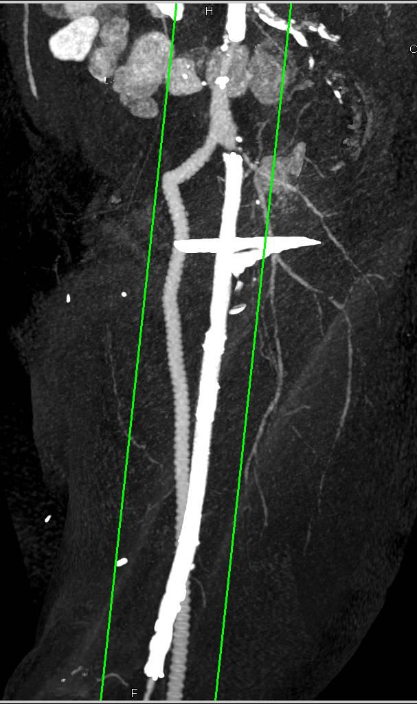 Superficial Femoral Artery (SFA) to Anterior Tibial Artery Bypass Graft - CTisus CT Scan