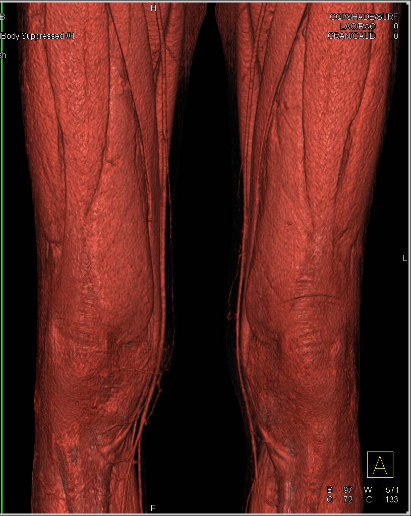 Peripheral Vascular Disease with Occlusion in Right Superficial Femoral Artery (SFA) Seen Nicely on CTA - CTisus CT Scan