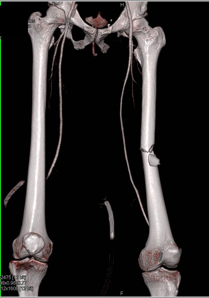 CTA Runoff with Injury to the Trifurcation Vessels - CTisus CT Scan