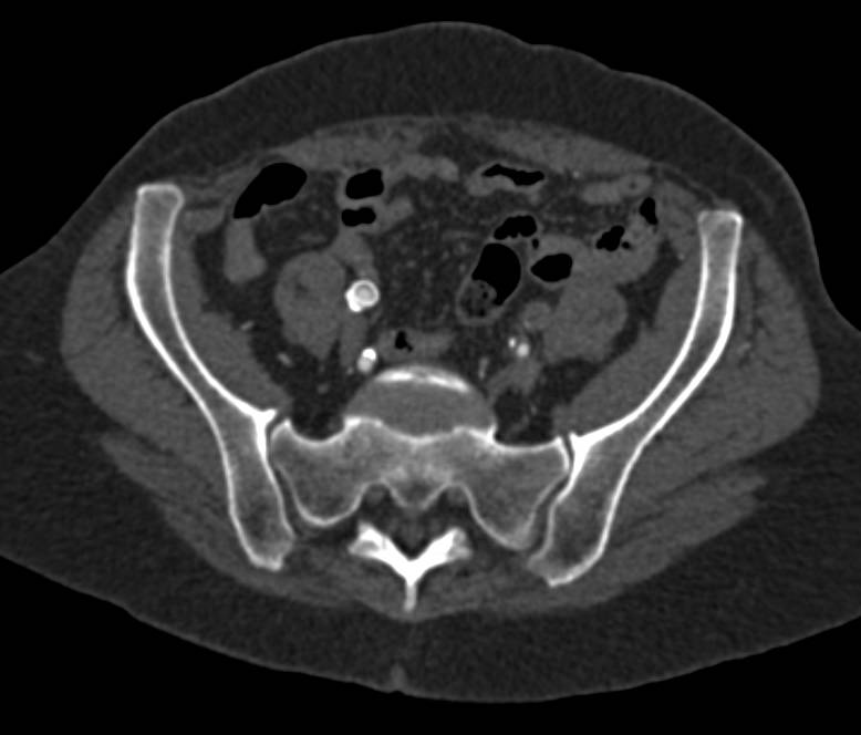 Right Superficial Femoral Artery (SFA) to Popliteal Artery Graft in Patient with PVD (Peripheral Vascular Disease) - CTisus CT Scan