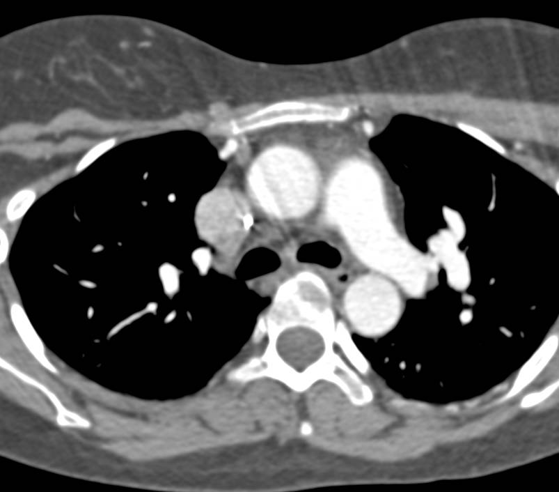 Ehlers-Danlos with Incredible Aneurysms Including Right Carotid, Left Subclavian and Hepatic Artery - CTisus CT Scan