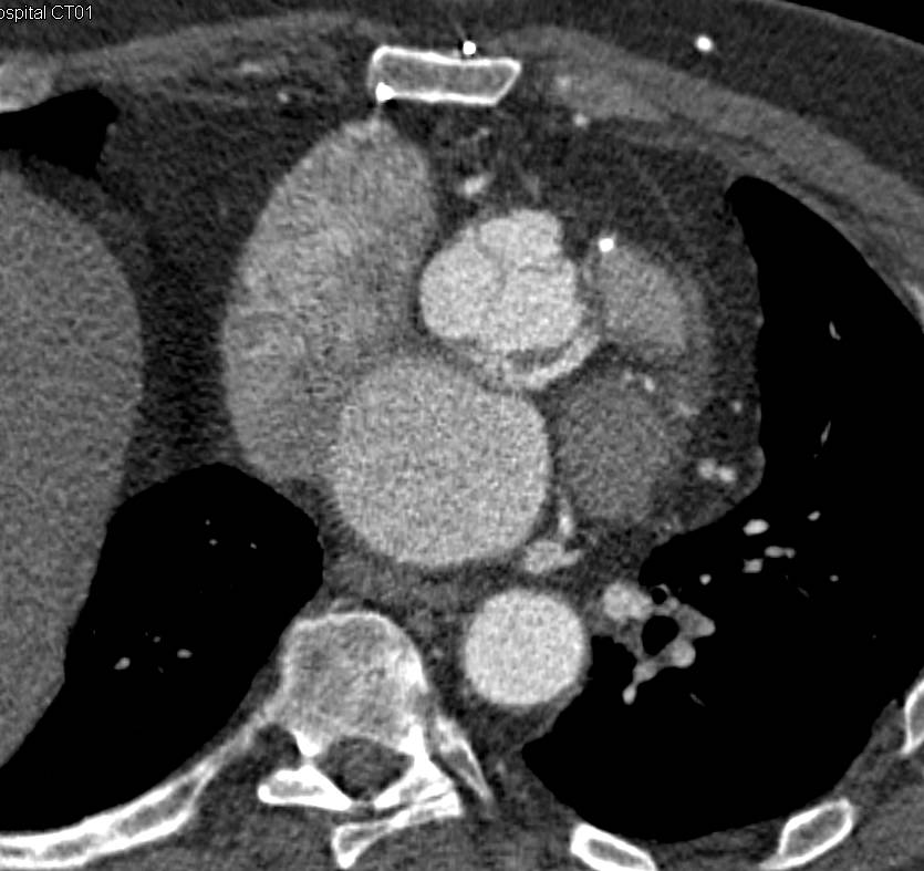 Center Like Tracking of Thoracic Aneurysm to get Exact Size Measurements - CTisus CT Scan