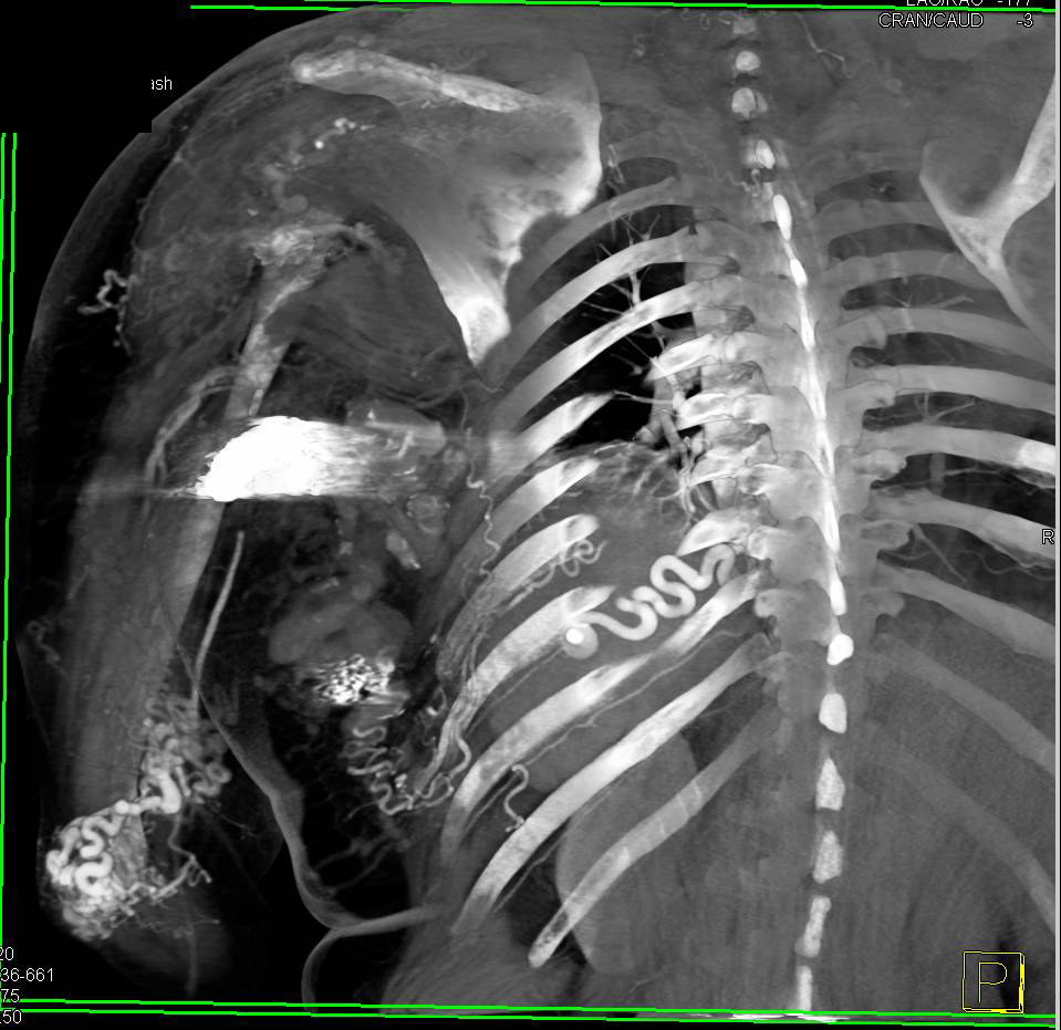 Arteriovenous Malformation (AVM) Left Chest Wall with Collaterals and Bypass Graft - CTisus CT Scan