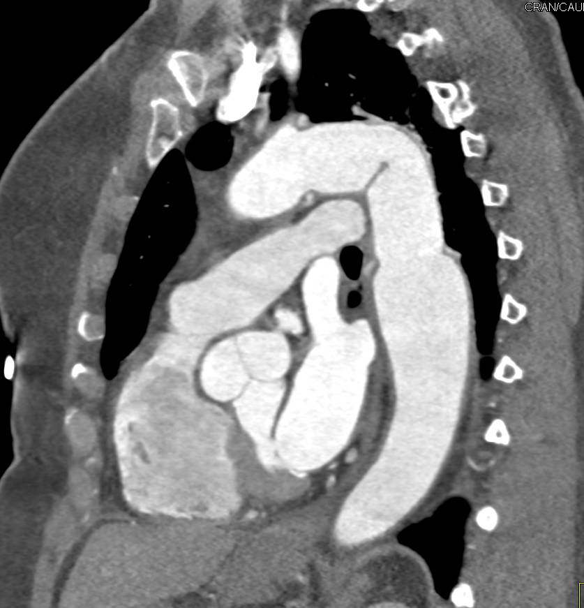 Arch Repair of a Dissection - CTisus CT Scan