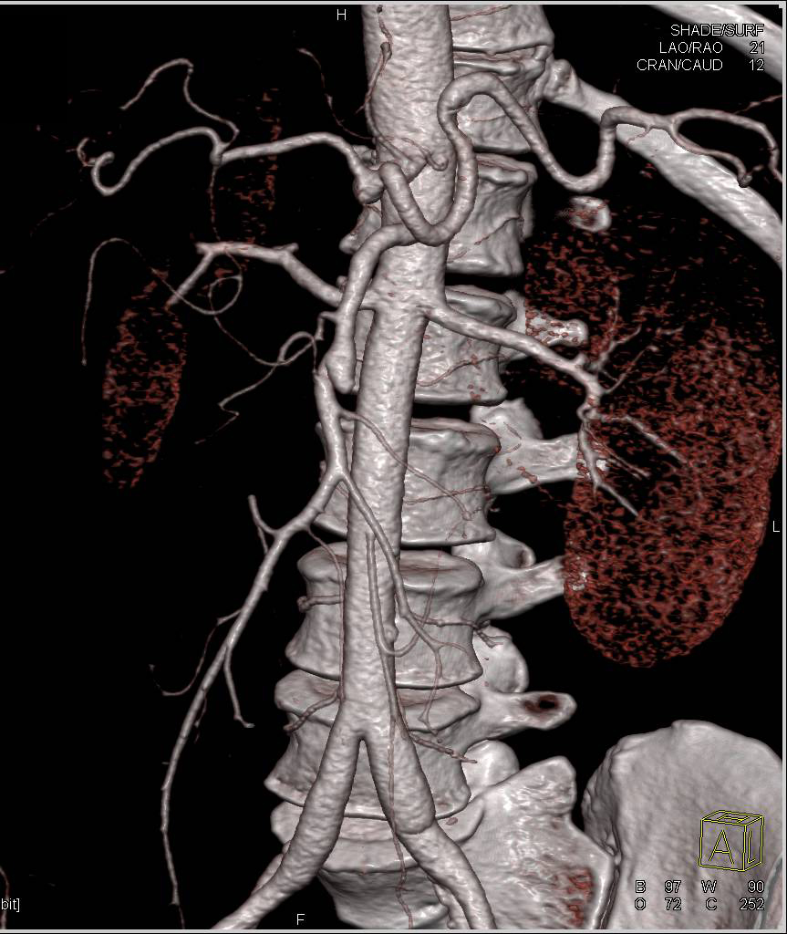 Superior Mesenteric Artery (SMA) Dissection Possibly due to Segmental Arterial Mediolysis - CTisus CT Scan