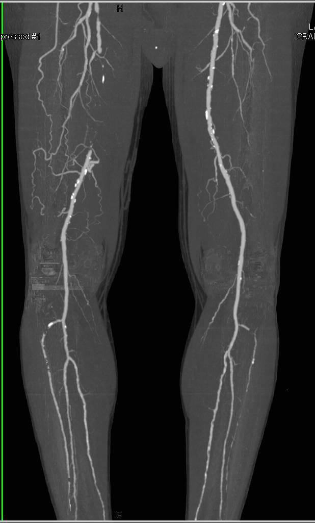 CTA Runoff with Occlusion of the Right Superficial Femoral Artery (SFA) with Collaterals Seen on DE Images - CTisus CT Scan