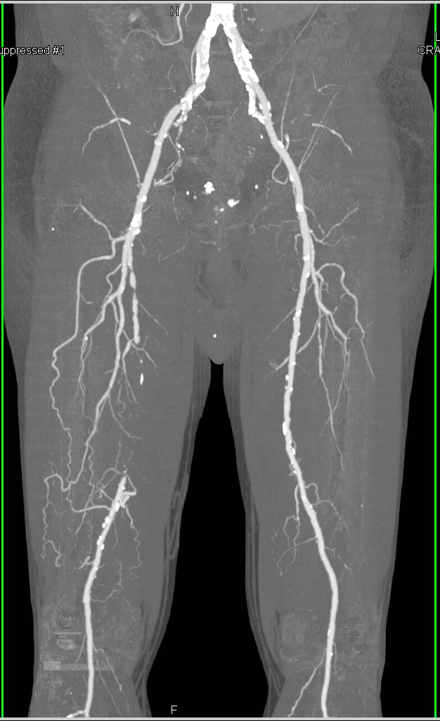 CTA Runoff with Occlusion of the Right Superficial Femoral Artery (SFA) with Collaterals Seen on DE Images and SE Images - CTisus CT Scan