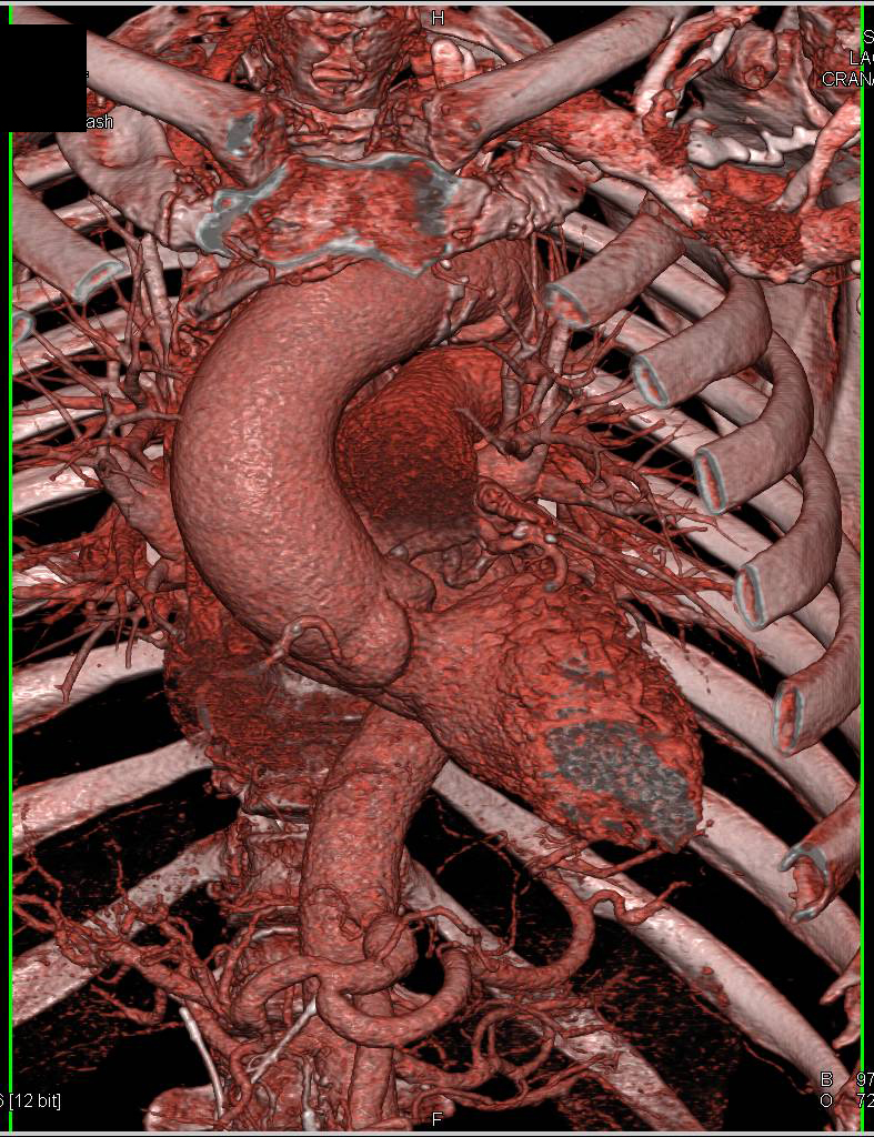 Dilated Aortic Root - CTisus CT Scan