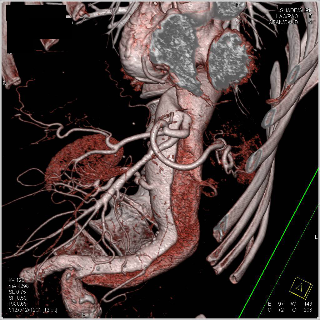 Type B Dissection - CTisus CT Scan