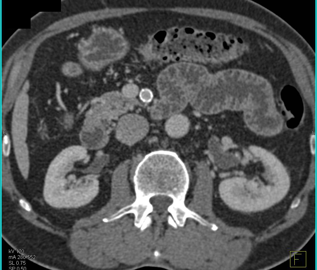 Patent Celiac and Superior Mesenteric Artery (SMA) Stents - CTisus CT Scan