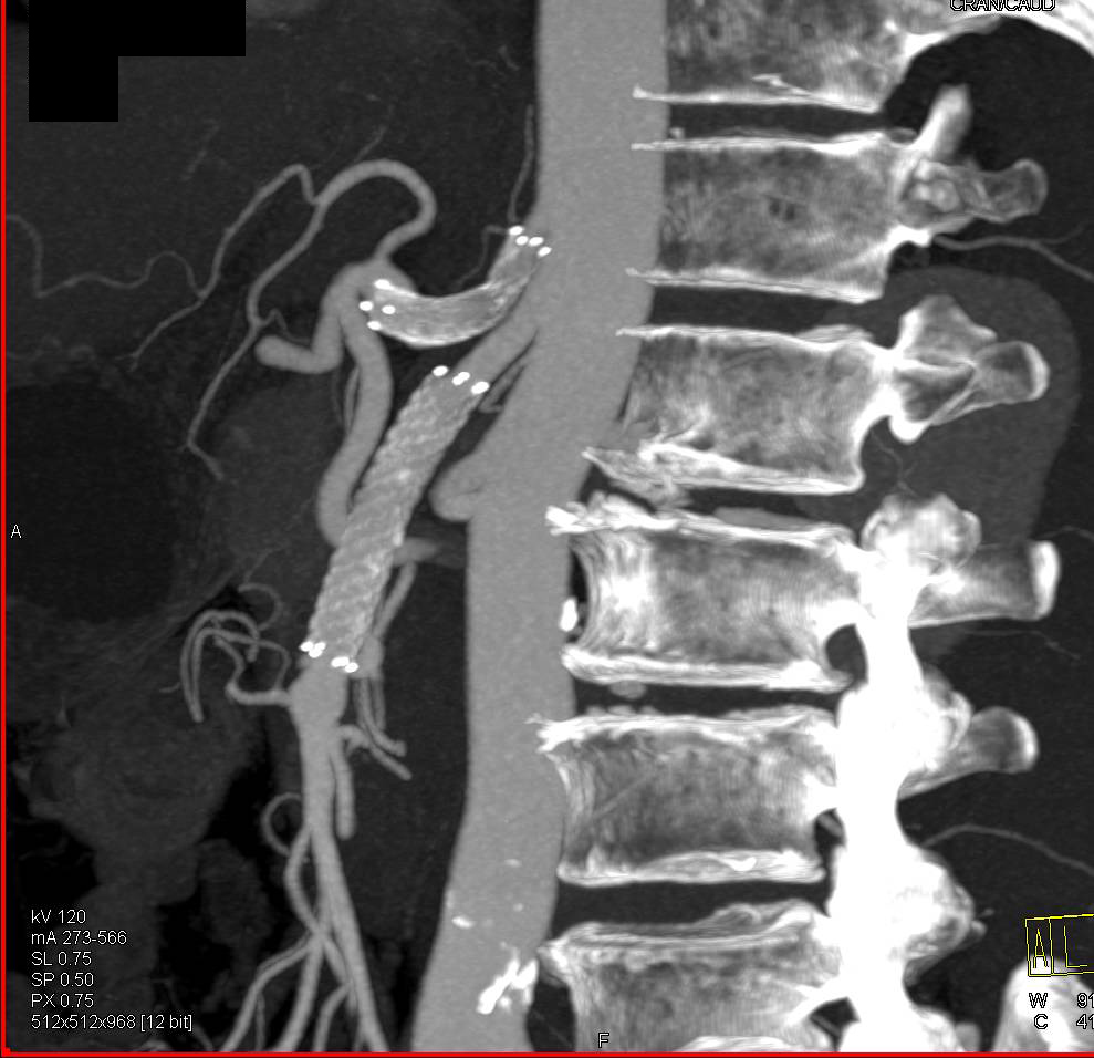 Patent Stents in the Celiac and SMA - CTisus CT Scan