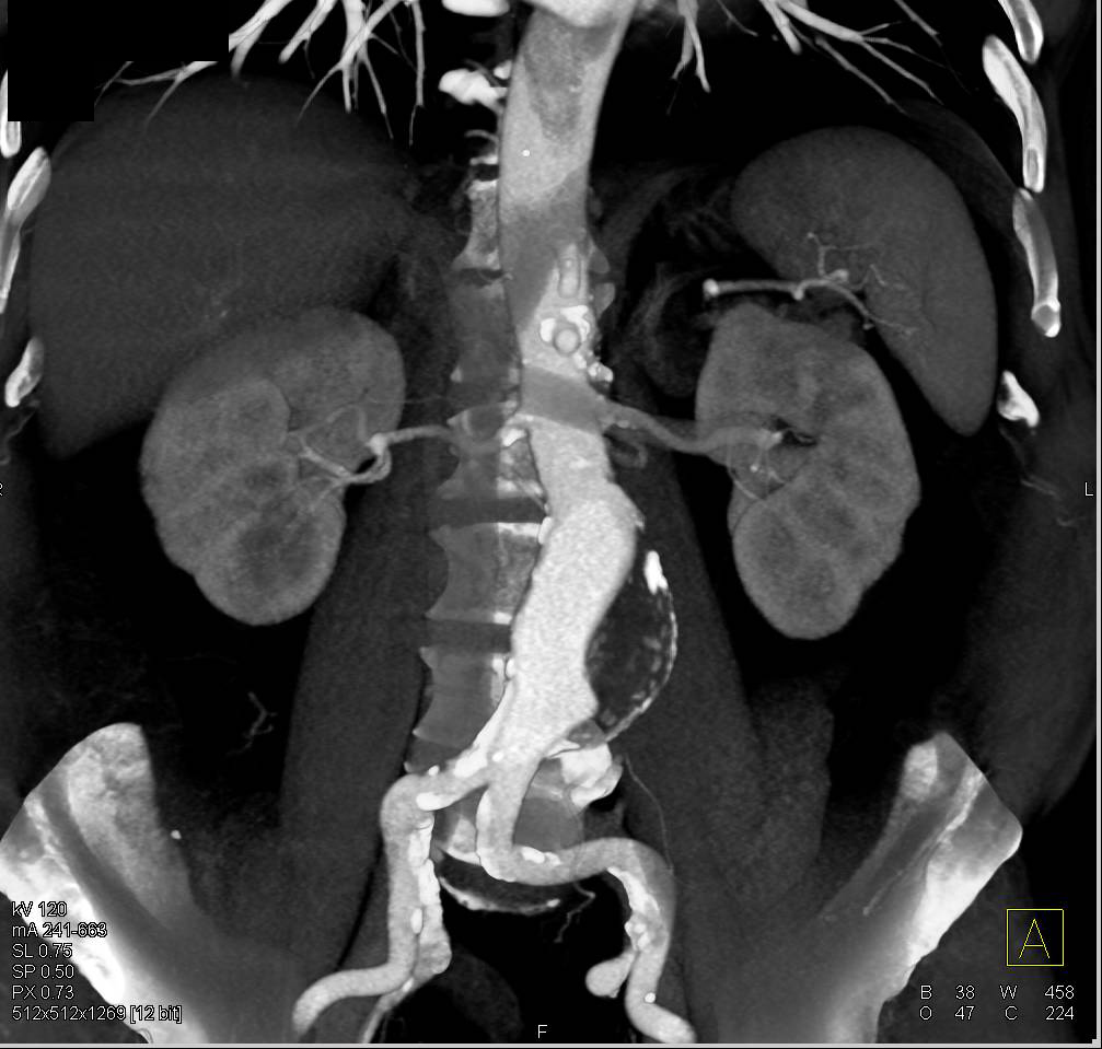 Abdominal Aortic Aneurysm - CTisus CT Scan