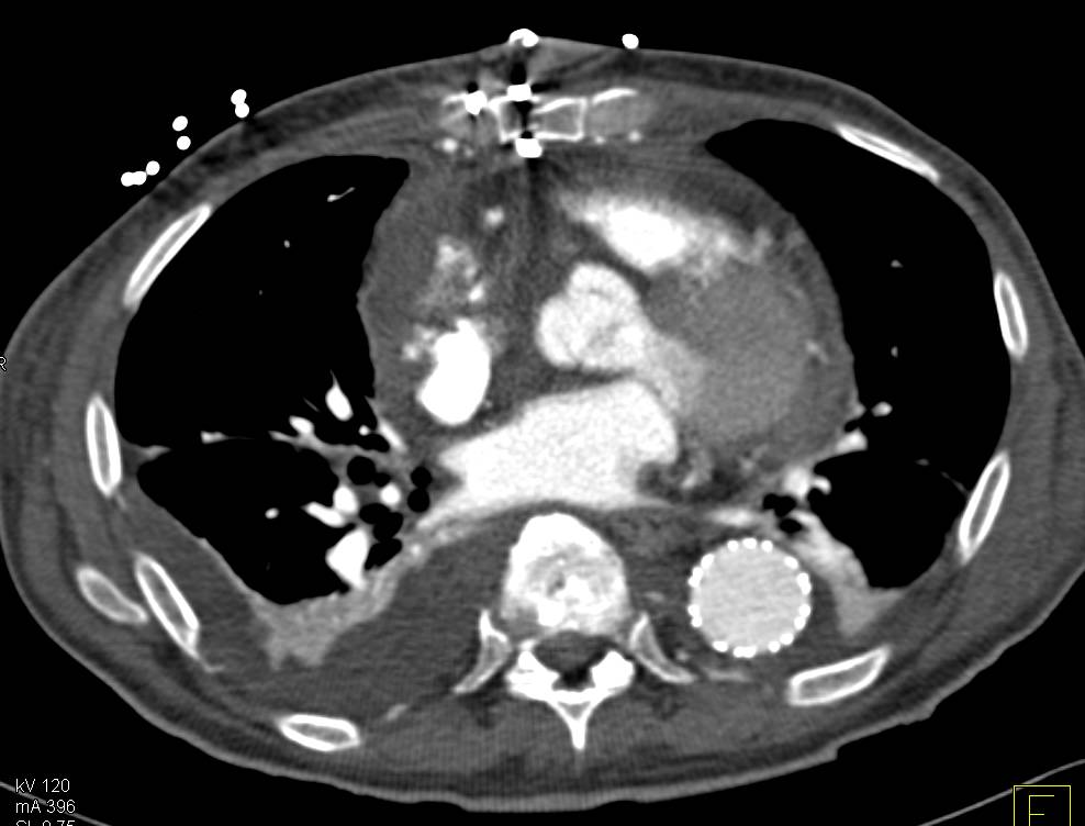 Aortic Dissection in Abdominal Aorta Following Repair of Thoracic Aorta - CTisus CT Scan