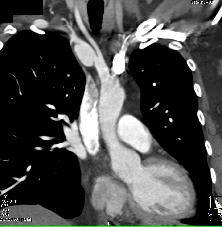 Right Subclavian Artery Aneurysm and Dissection - CTisus CT Scan