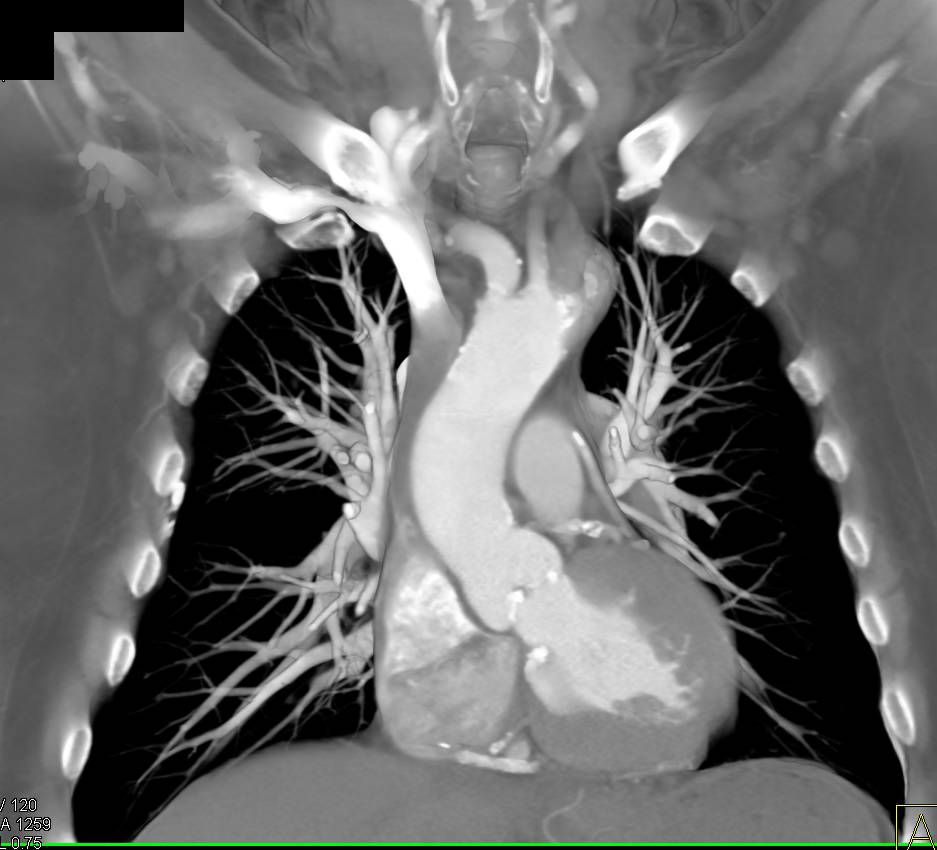 Aortic Valve Calcification and Endovascular Stents in Abdominal Aorta - CTisus CT Scan