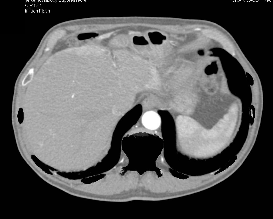 Automated Bone Removal with Peripheral Vascular Disease - CTisus CT Scan