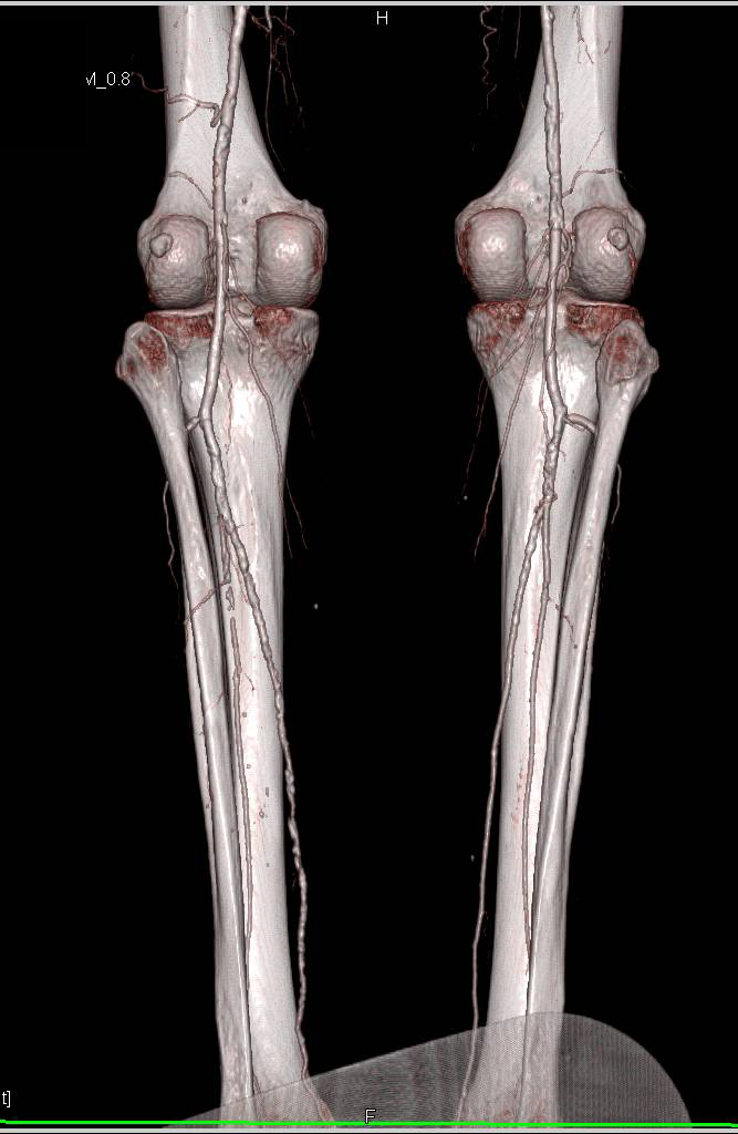 CTA Runoff with Peripheral Vascular Disease (PVD) - CTisus CT Scan