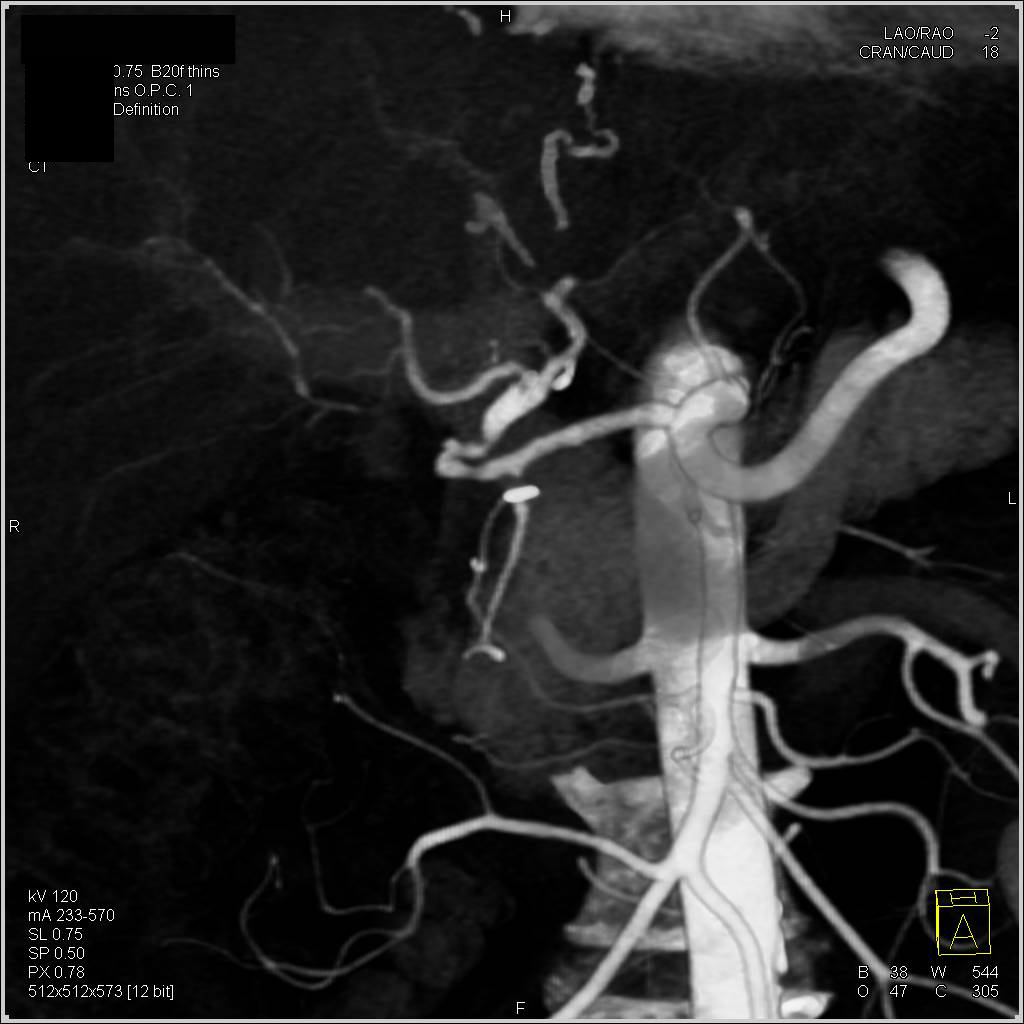 Hepatic Artery Dilated at Anastomosis for Liver Transplant - CTisus CT Scan