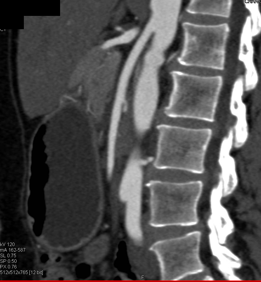Superior Mesenteric Artery (SMA) Syndrome - CTisus CT Scan
