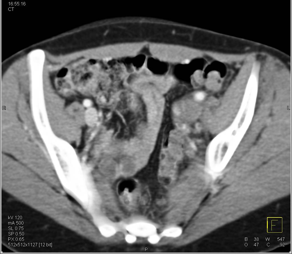 Occlusion of the Left Iliac Vein - CTisus CT Scan