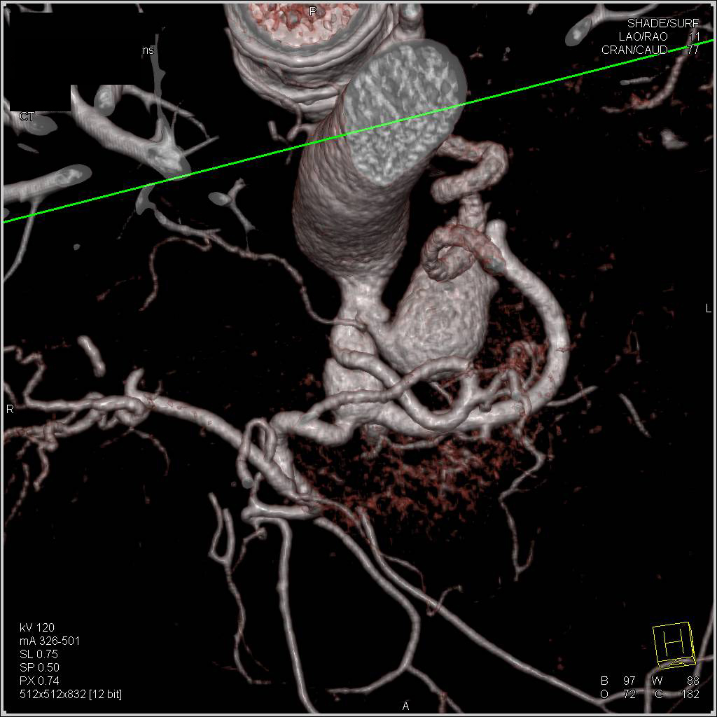 Celiac Artery Aneurysm - CTisus CT Scan