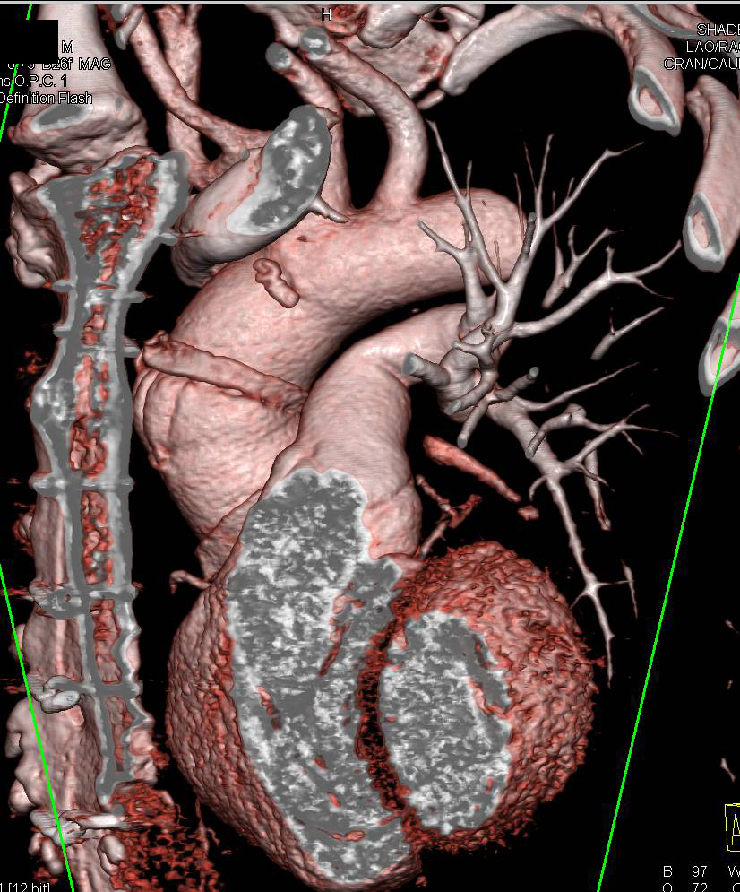 Type A Dissection Post Repair - CTisus CT Scan