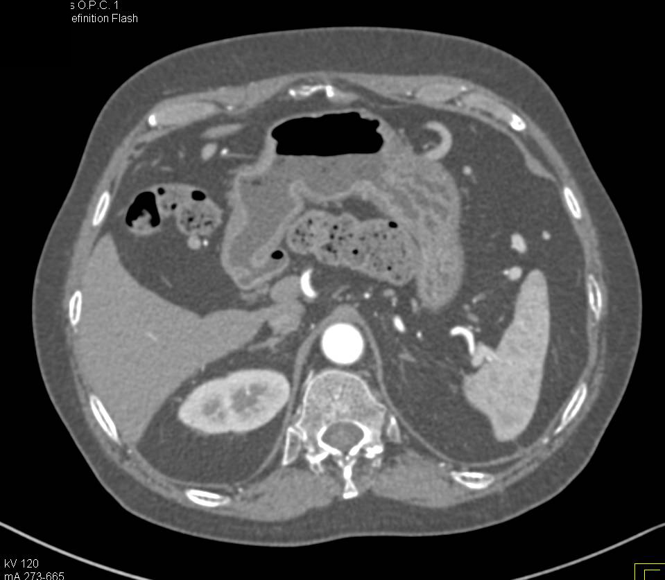 Retroperitoneal Fibrosis Encases the Aorta - CTisus CT Scan