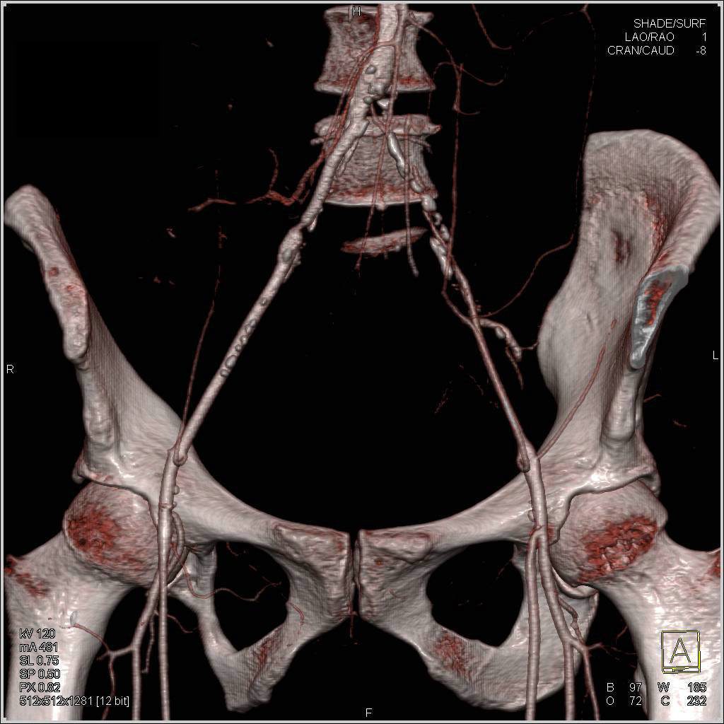 Occluded Left Common Iliac Artery - CTisus CT Scan