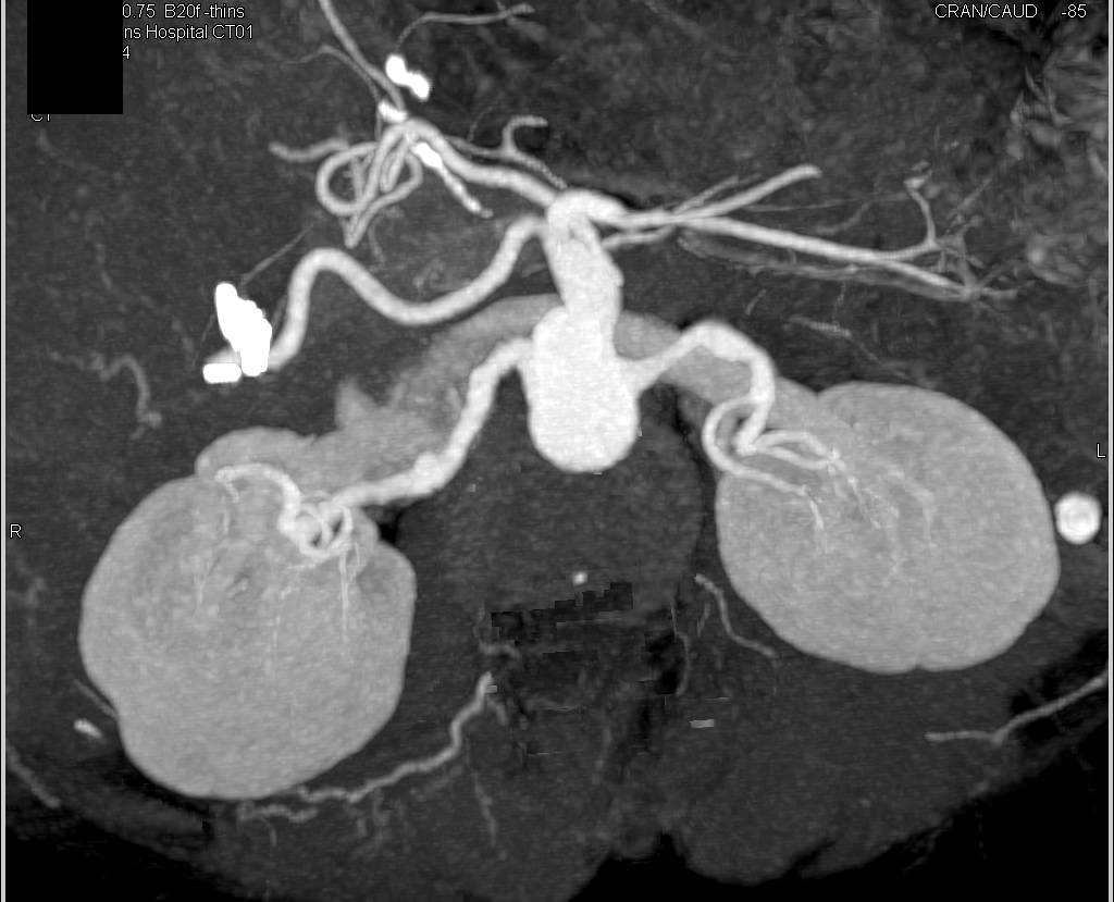 Fibromuscular Dysplasia (FMD) Left Renal Artery and Celiac Artery Aneurysm - CTisus CT Scan