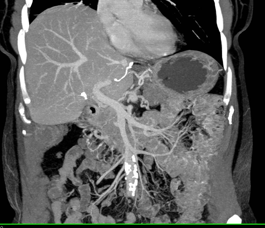 Complex Vascular Disease with Fibromuscular Dysplasia (FMD) Right Renal Artery, Celiac Aneurysm, and Superior Mesenteric Artery (SMA) Stenosis - CTisus CT Scan