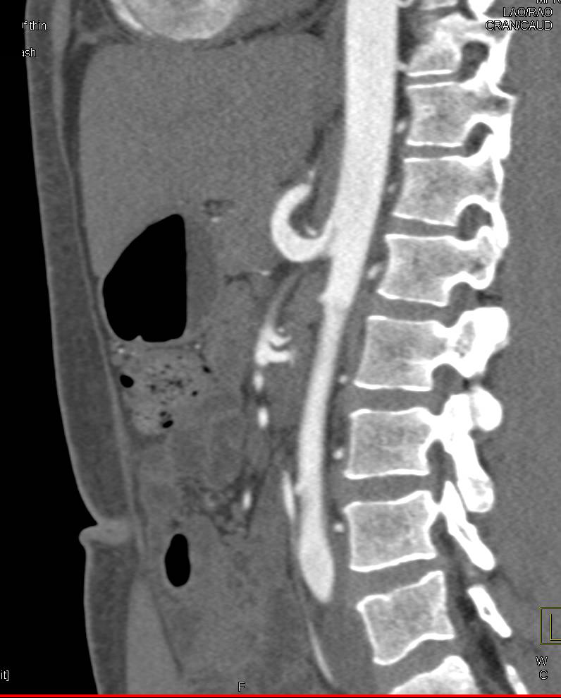3D Imaging of Median Arcuate Ligmant syndrome - CTisus CT Scan