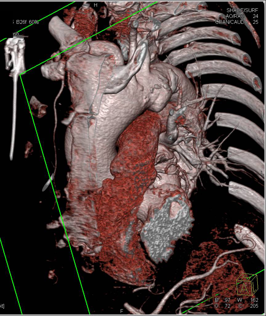 Ductus Aneurysm in 3D - CTisus CT Scan