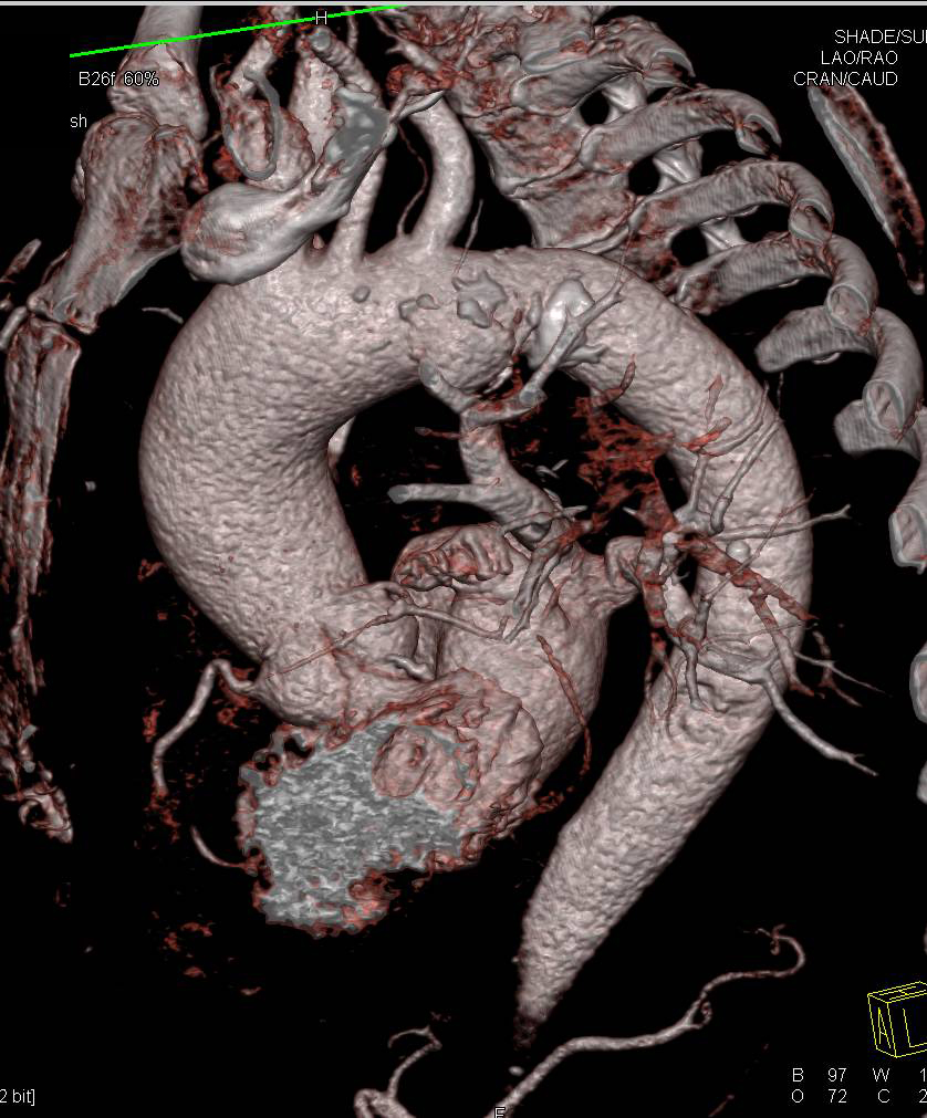 Ductus Aneurysm - CTisus CT Scan
