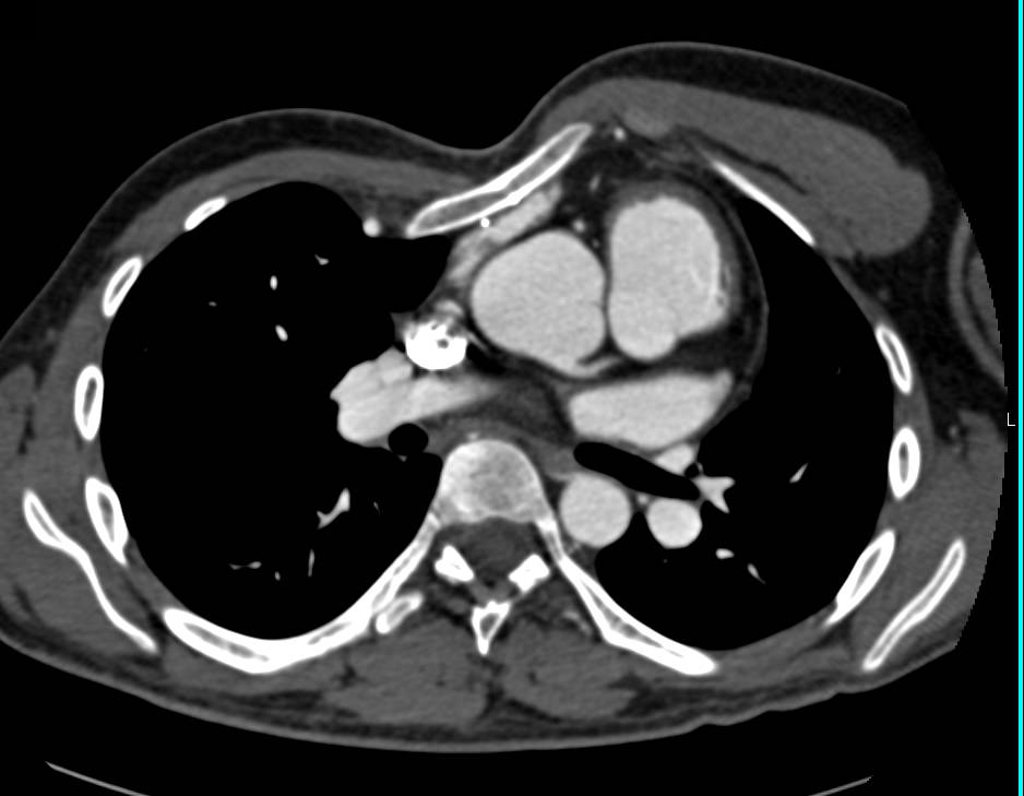 Marfan Syndrome with Dilated Sinus of Valsalva and Pectus Deformity - CTisus CT Scan