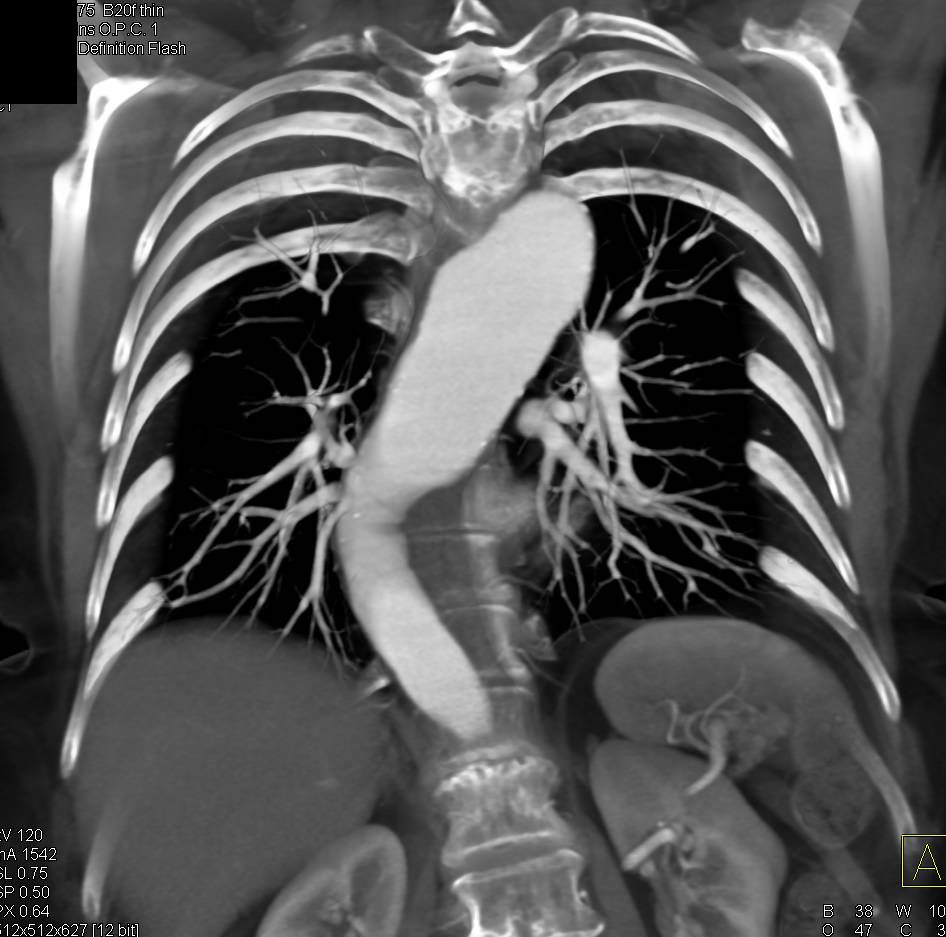 Descending Thoracic Aortic Aneurysm - CTisus CT Scan