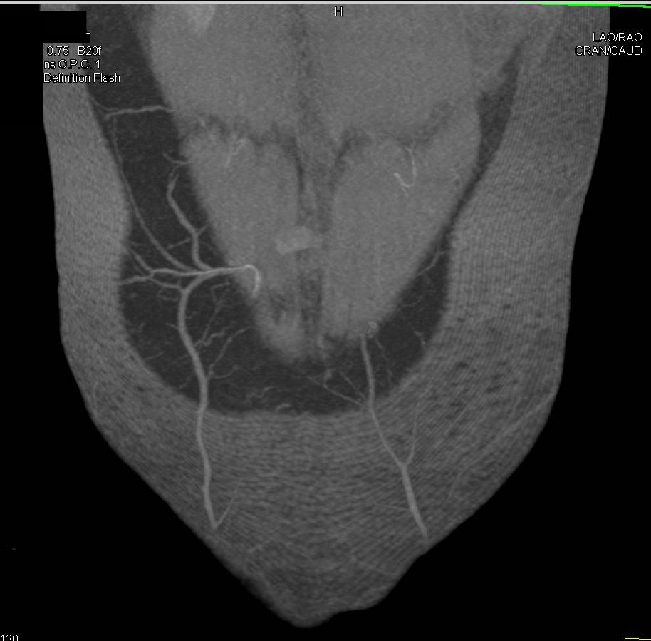 DIEP Flap Planning for Breast Reconstructive Surgery - CTisus CT Scan