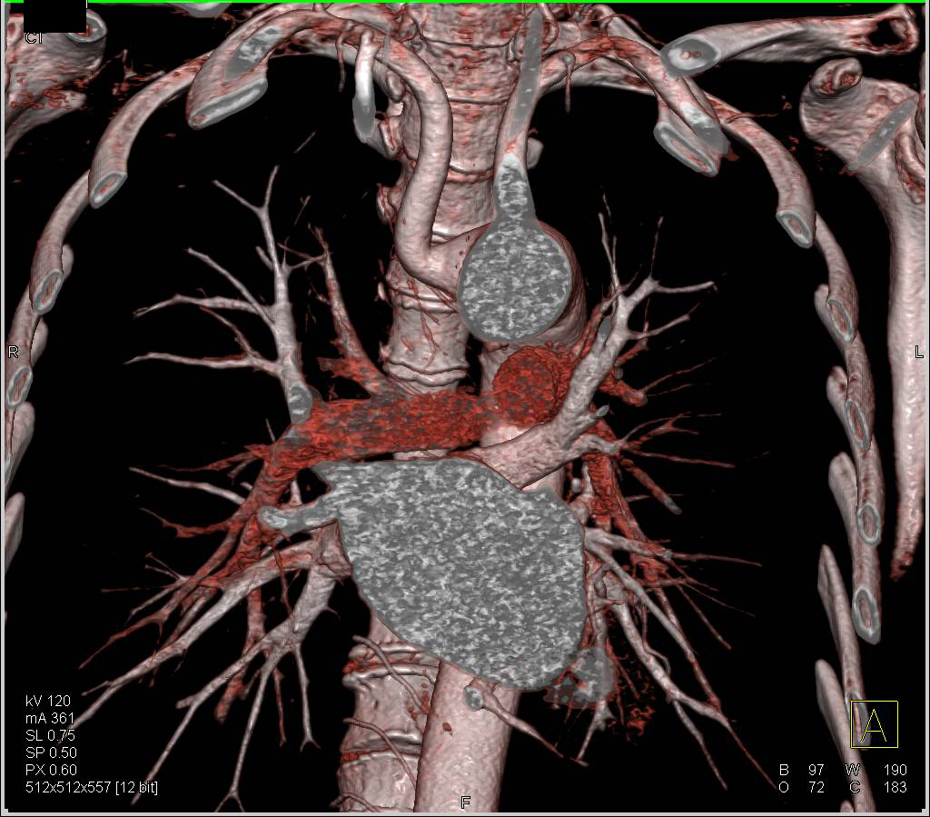Aberrant Right Subclavian Artery in Patient with Dilated Ascending Aorta - CTisus CT Scan