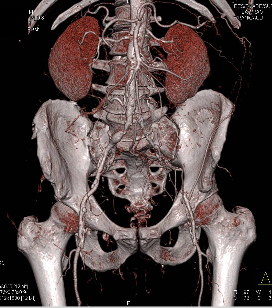 VRT Rendering of Severe Peripheral Vascular Disease (PVD) - CTisus CT Scan