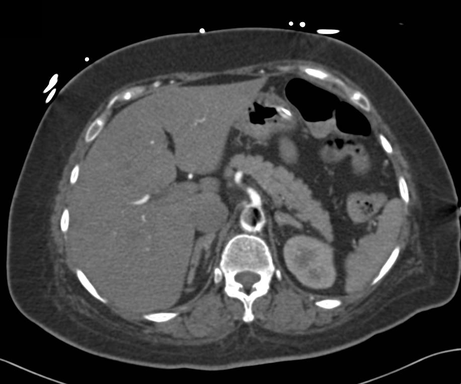 CT Imaging of an Intra-Aortic Balloon Pump With Classic Pseudo clot - CTisus CT Scan